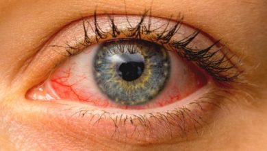 أمراض سطح العين